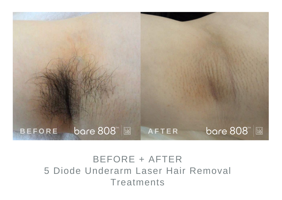 Before and After Underarm Laser Hair Removal