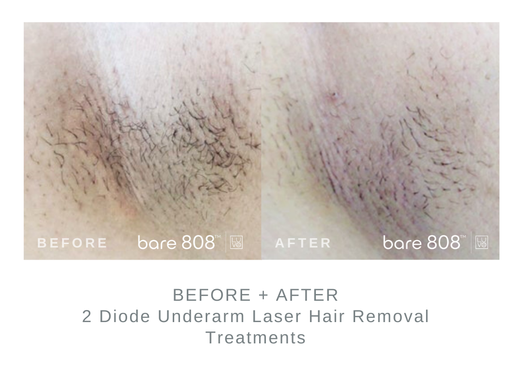 Before and After Underarm Diode Laser Hair Removal 
