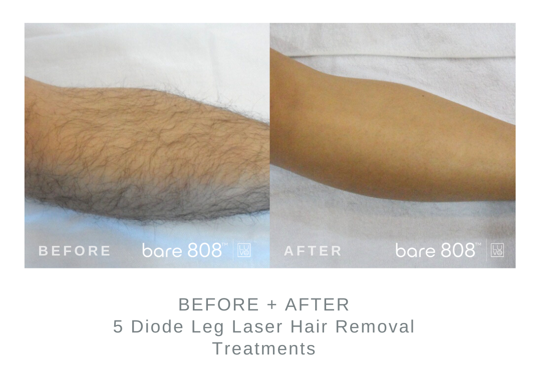 Before and After Leg Laser Hair Removal 