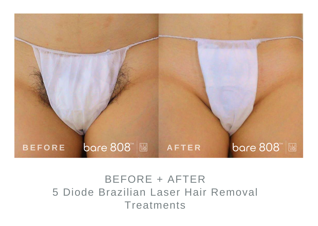 Before and After Brazilian Laser Hair Removal