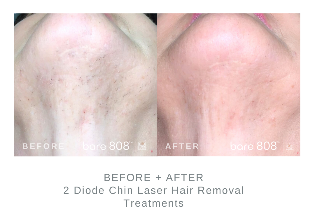 Before and After Chin Laser Hair Removal 