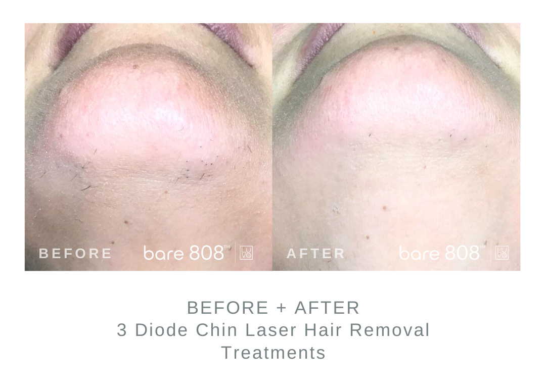 Before and After Chin Laser Hair Removal 