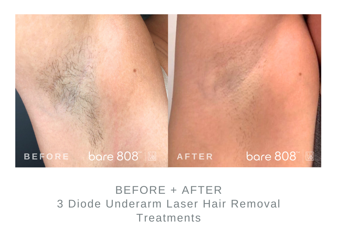 Before and After Underarm Laser Hair Removal