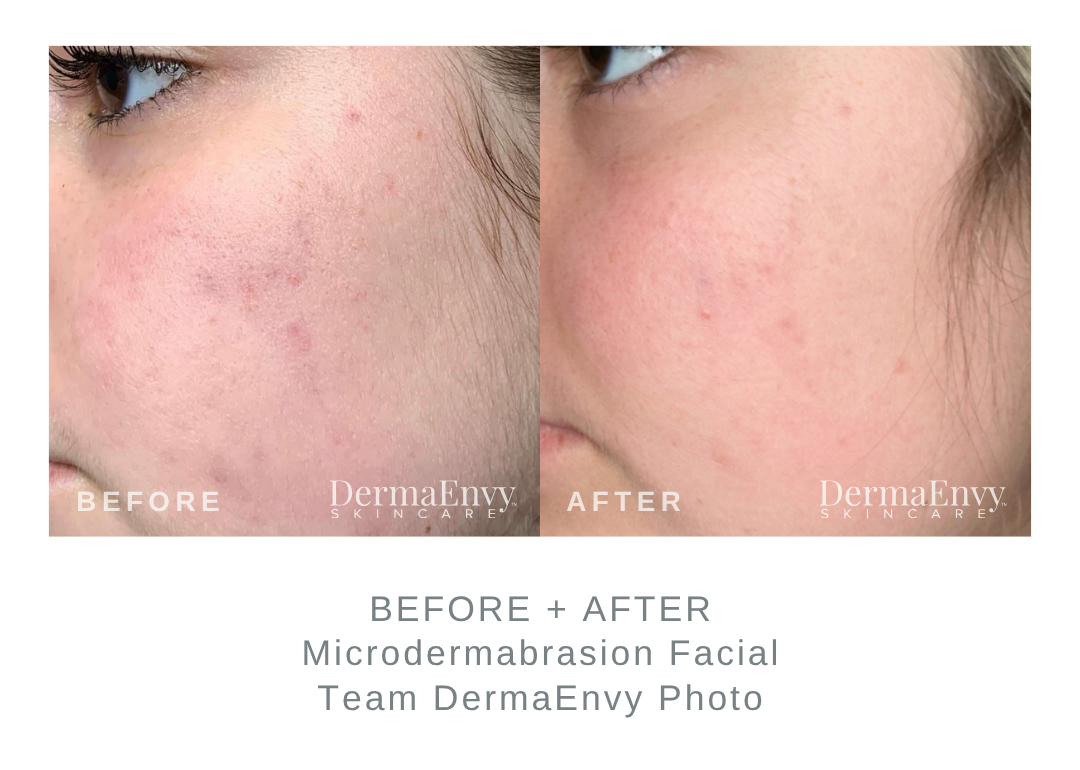 Before and After Microdermabrasion Facial | DermaEnvy Skincare