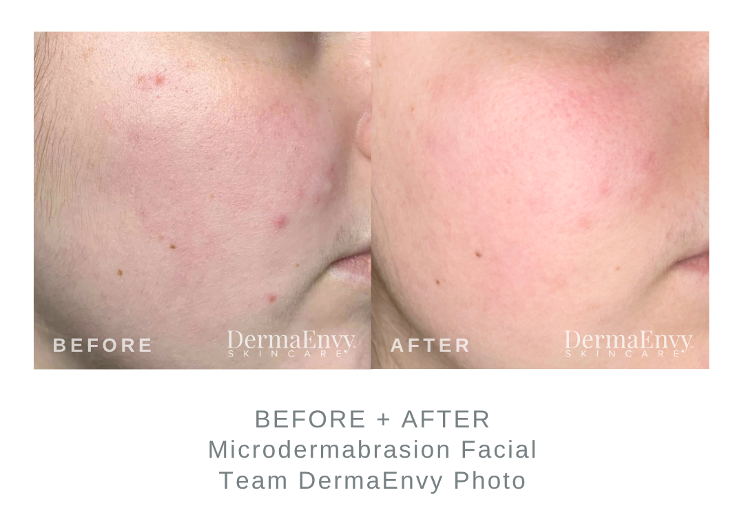Before and After Microdermabrasion Facial on Face | DermaEnvy Skincare 
