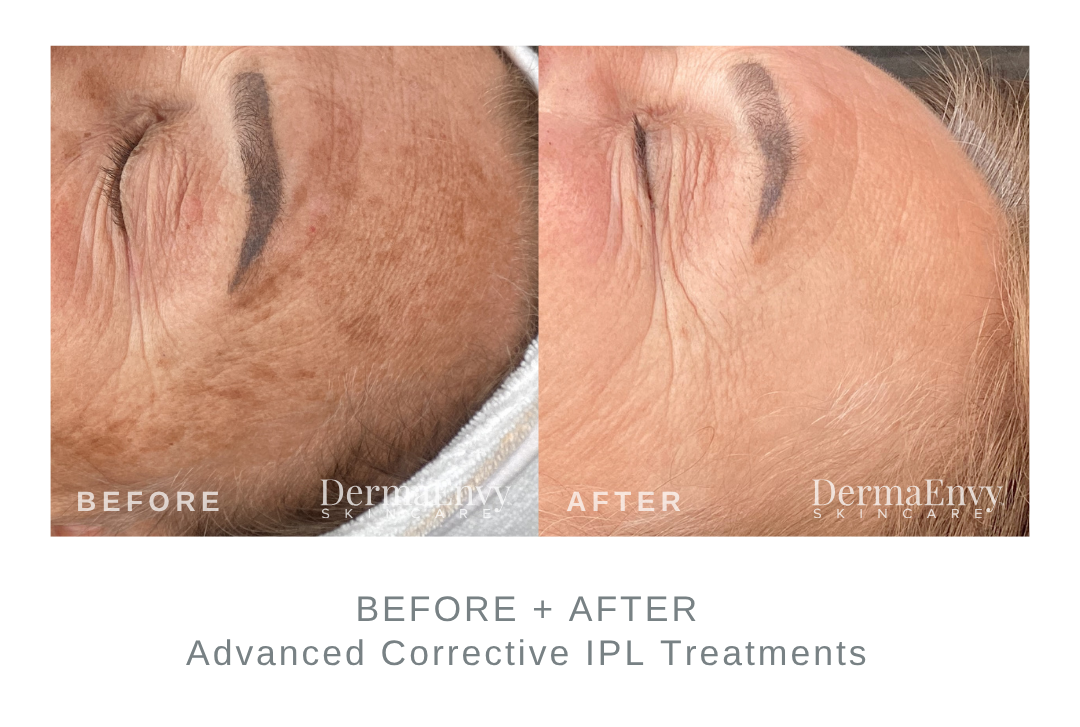Before and After Advanced Corrective IPL Age Spot Treatments DermaEnvy Skincare