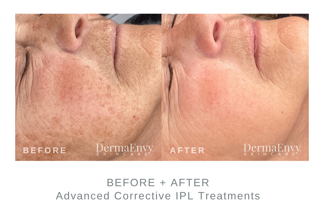 Before and After Advanced Corrective IPL Sun Spots Treatment DermaEnvy Skincare
