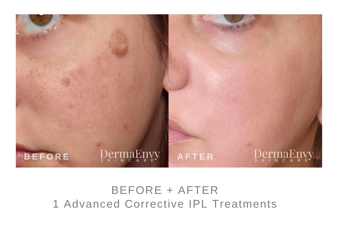 Before and After Advanced Corrective IPL Hormonal Pigmentation Treatment DermaEnvy Skincare 