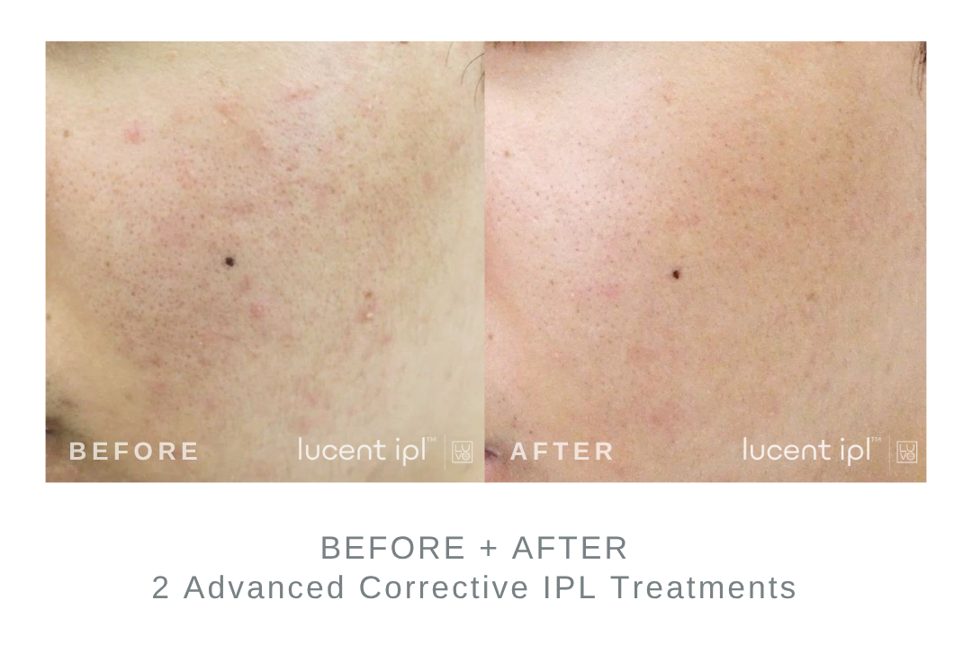 Before and After Advanced Corrective IPL Uneven Skin Tone Treatment DermaEnvy Skincare
