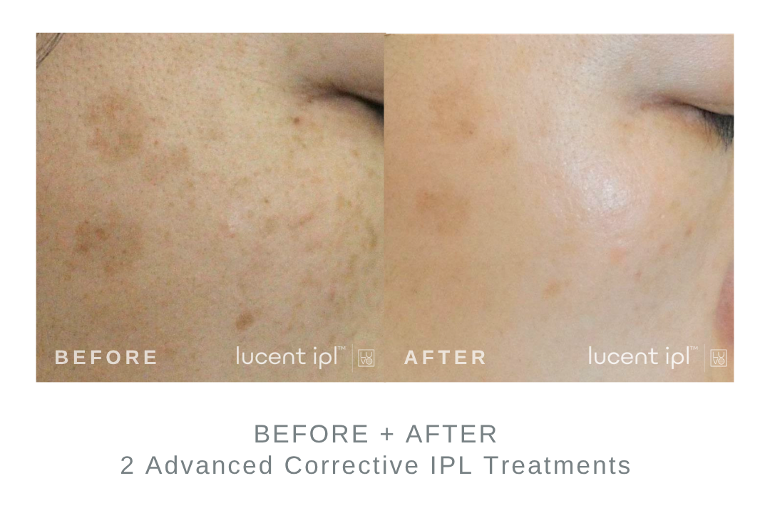 Before and After Advanced Corrective IPL Pigmented Lesion Treatment DermaEnvy Skincare