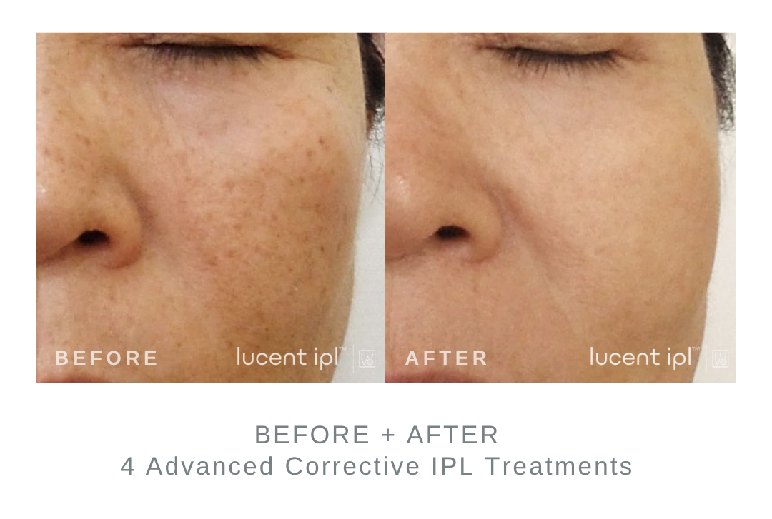 Before and After Advanced Corrective IPL Sun Spot Treatment DermaEnvy Skincare