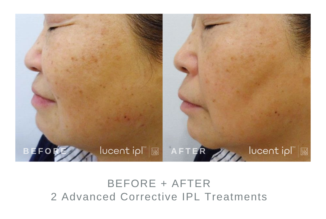 Before and After Advanced Corrective IPL Skin Firming Treatment DermaEnvy Skincare
