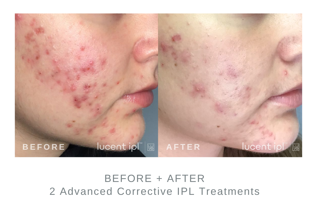 Before and After Advanced Corrective IPL Acne Treatments DermaEnvy Skincare