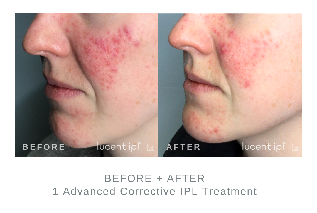 Before and After Advanced Corrective IPL Acne Treatment DermaEnvy Skincare