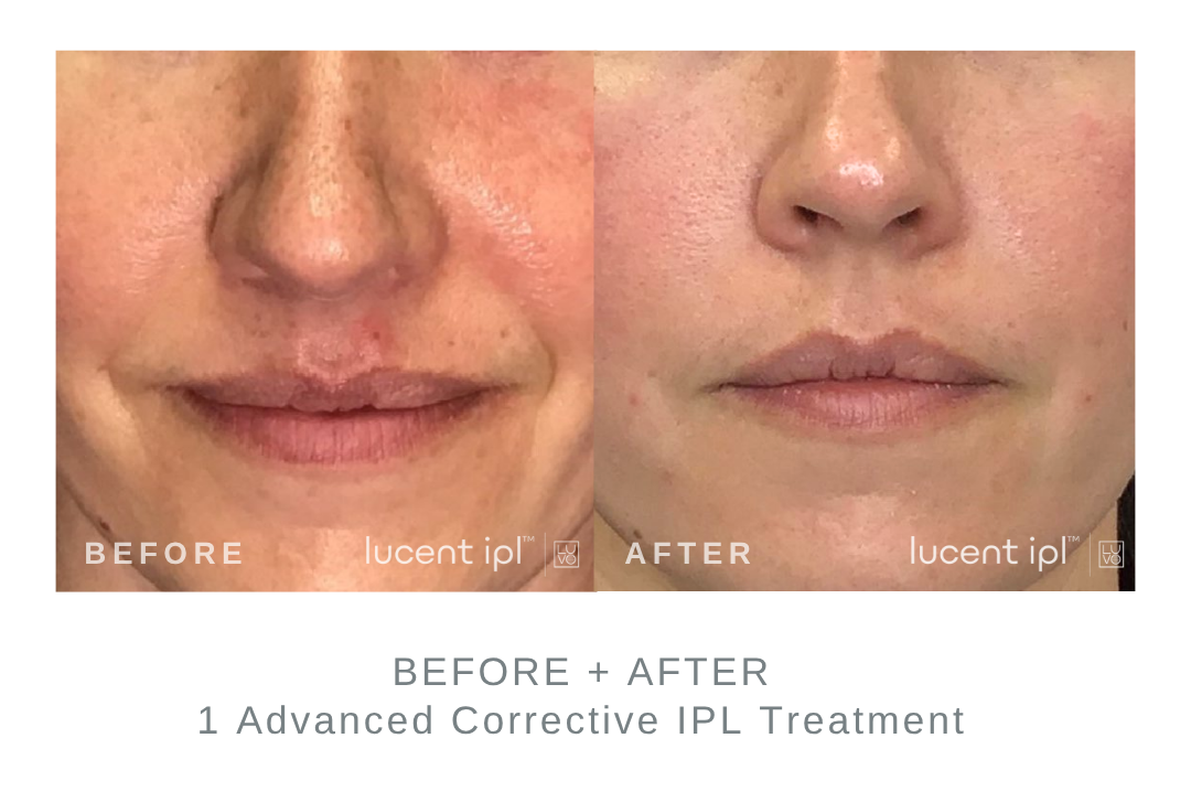 Before and After Advanced Corrective IPL Tone + Spot Treatment DermaEnvy Skincare
