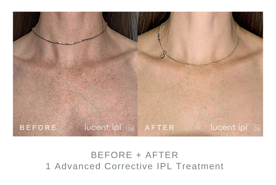Before and After Advanced Corrective IPL Neck + Chest Sun Spot Treatment DermaEnvy Skincare