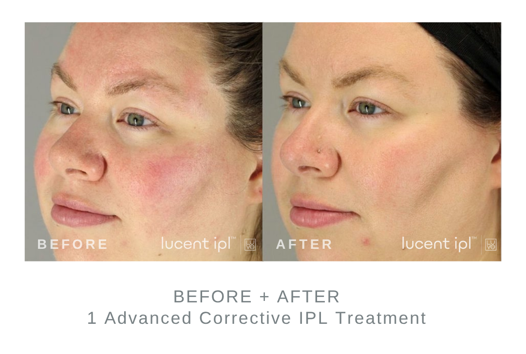 Before and After Advanced Corrective IPL Rosacea Treatment DermaEnvy Skincare