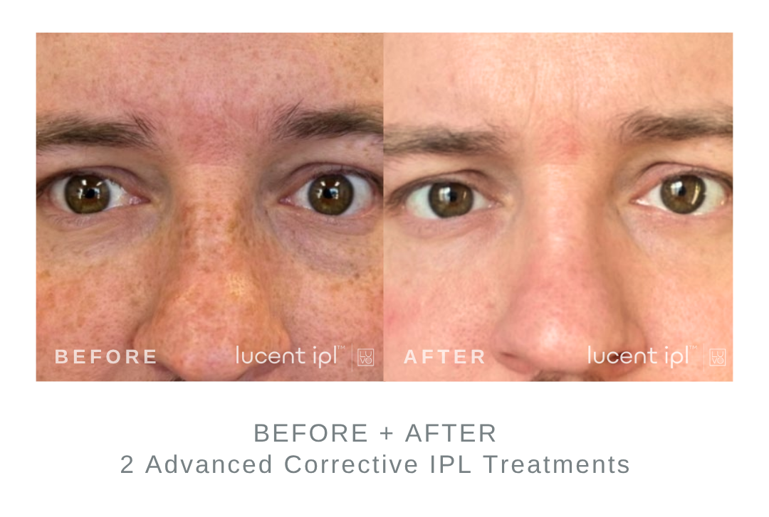 Before and After Advanced Corrective IPL Freckles and Sun Spot Treatments DermaEnvy Skincare
