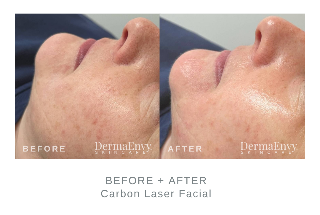 Before and After Carbon Laser Facial