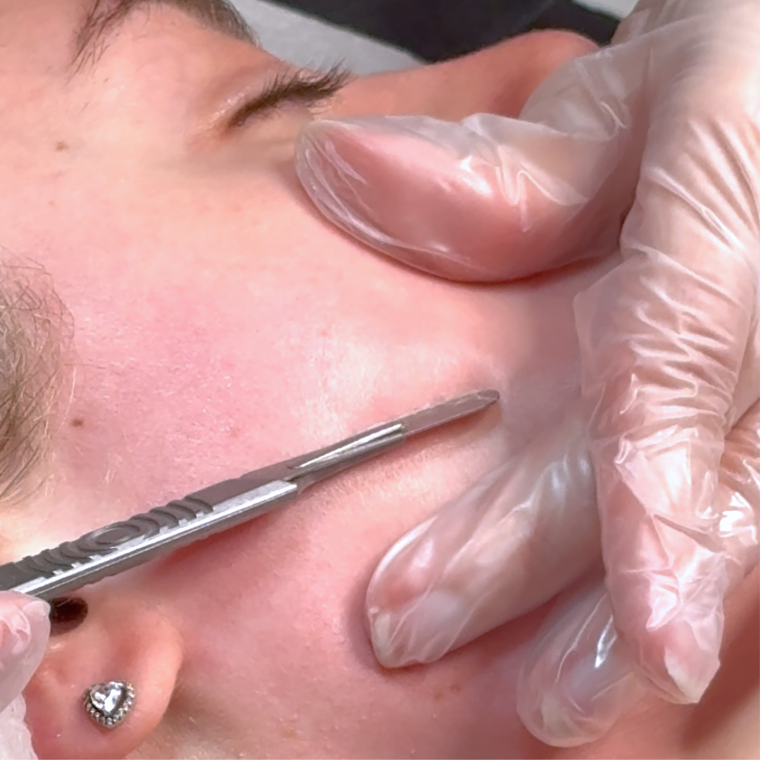 What Does a Dermaplane Facial Do?