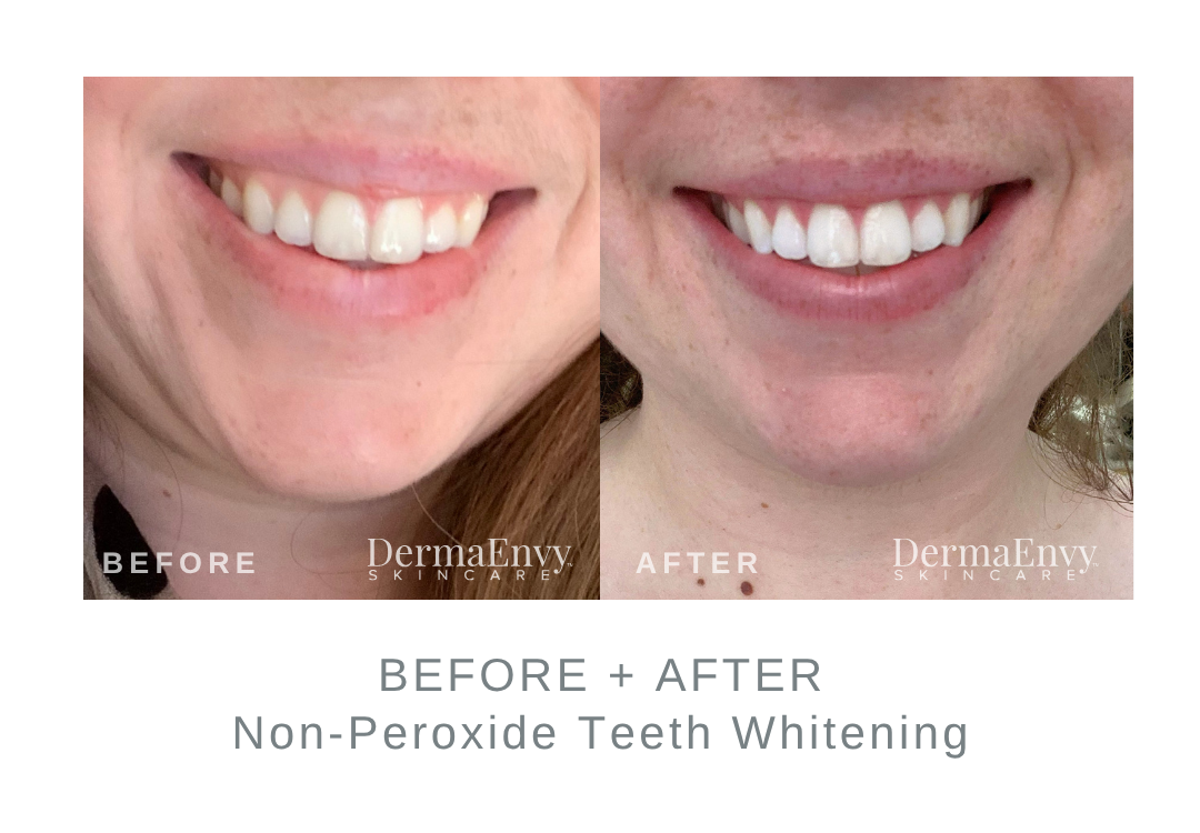 Before and After Non-Peroxide Teeth Whitening | DermaEnvy Skincare