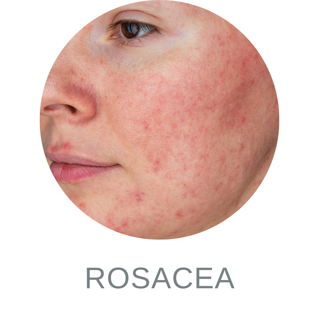 Rosacea