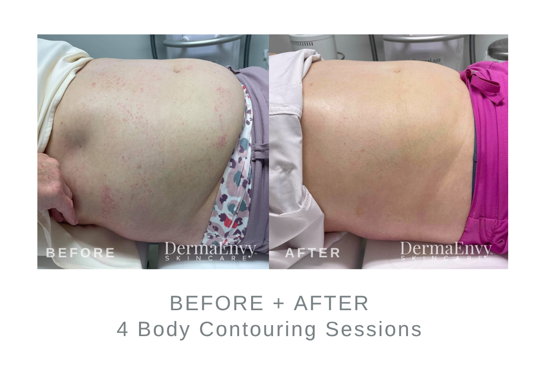 Before and After Body Contouring | DermaEnvy Skincare