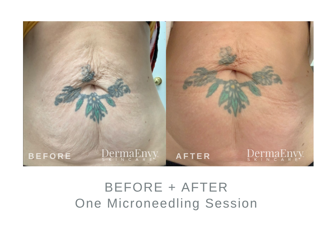 Before and After Microneedling for Skin Laxity | DermaEnvy Skincare
