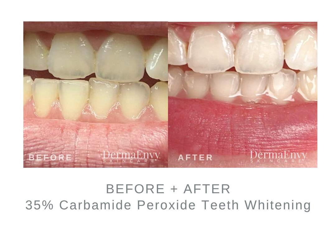 Before and After Carbamide Peroxide Teeth Whitening | DermaEnvy Skincare