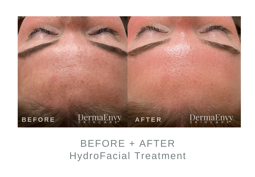 Before + After HydroFacial for Dry Skin | DermaEnvy Skincare