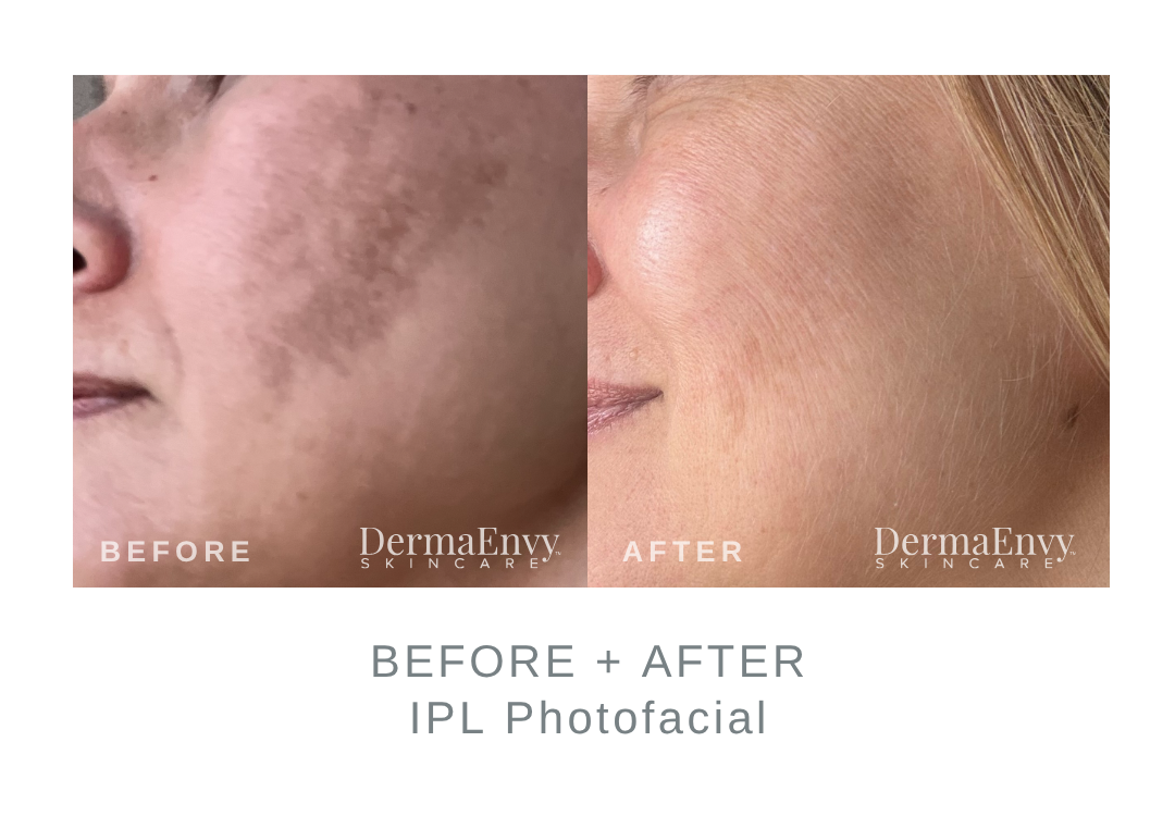 Before and After IPL Photofacial for Portwine Stains | DermaEnvy Skincare