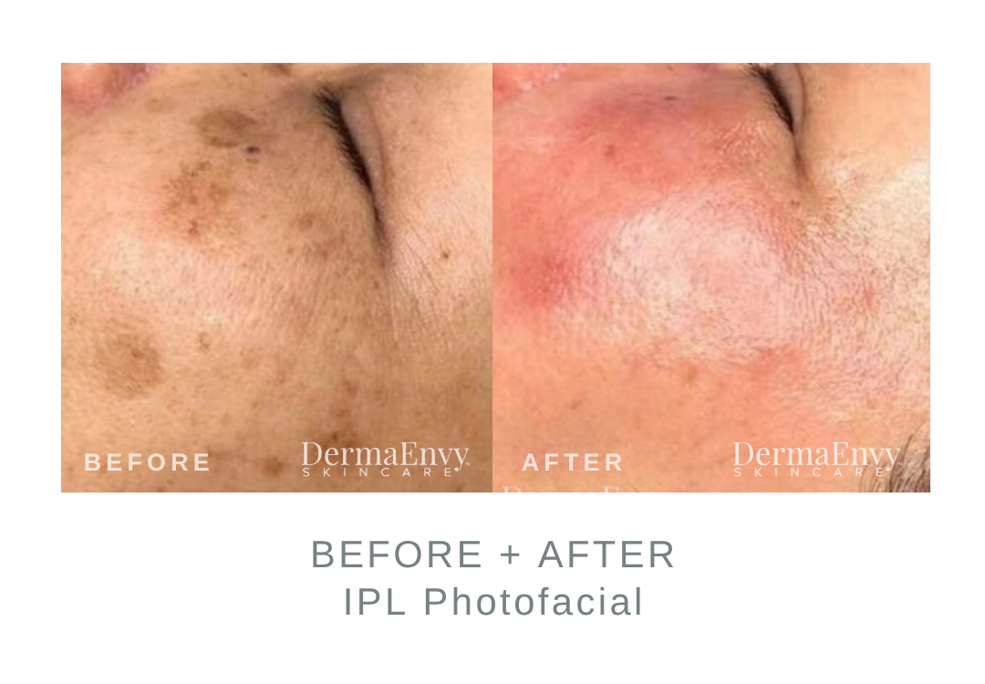 Before and After IPL Photofacial for Sun and Age Spots | DermaEnvy Skincare
