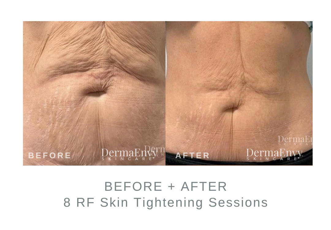 Before and After RF Skin Tightening on the Stomach | DermaEnvy Skincare