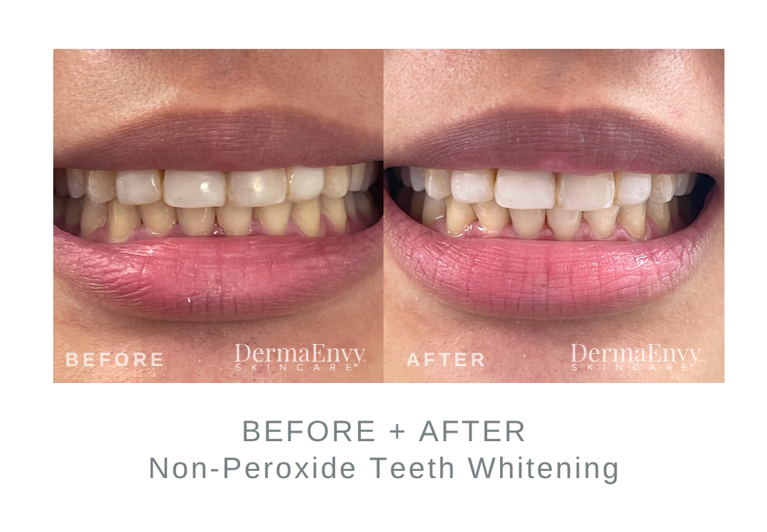Before and After Teeth Whitening | DermaEnvy Skincare 