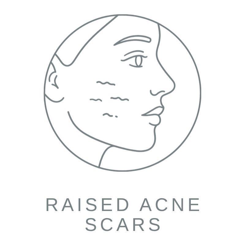 Raised Acne Scars 