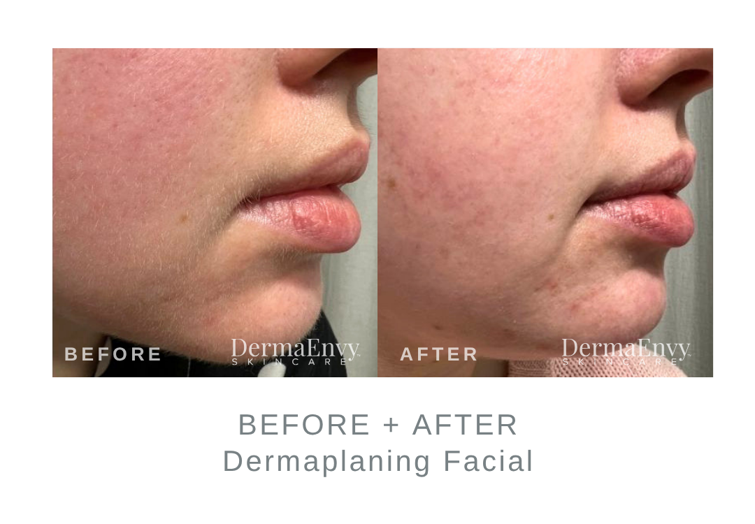 Before and After Dermaplaning for Peach Fuzz | DermaEnvy Skincare