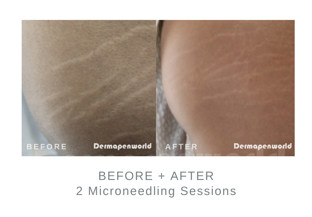 Before and After Microneedling for Stretch Marks | DermaEnvy Skincare