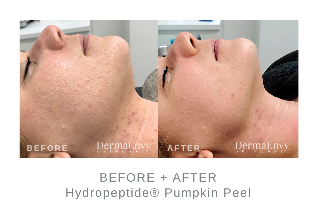 Before + After Hydropeptide Pumpkin Peel | DermaEnvy Skincare
