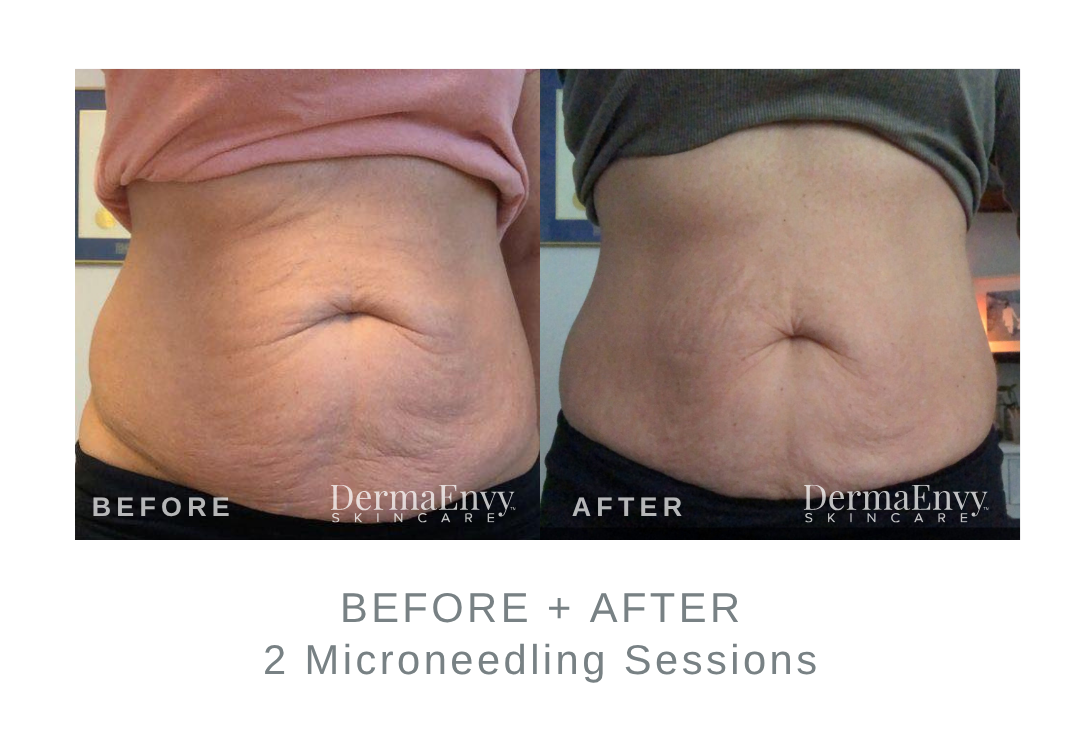 Before and After Microneedling for Loose Skin | DermaEnvy Skincare