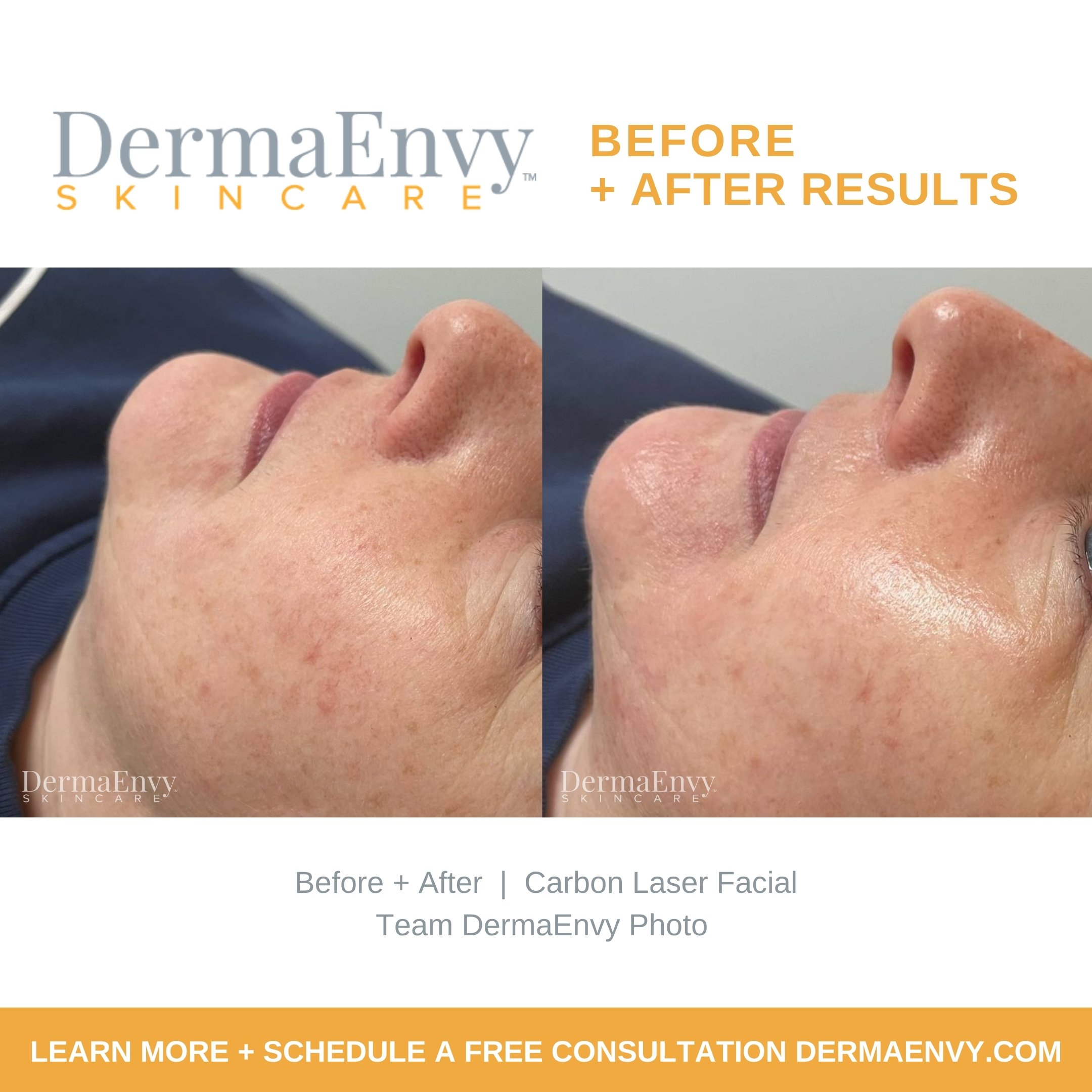 Carbon Laser Facial Before and After