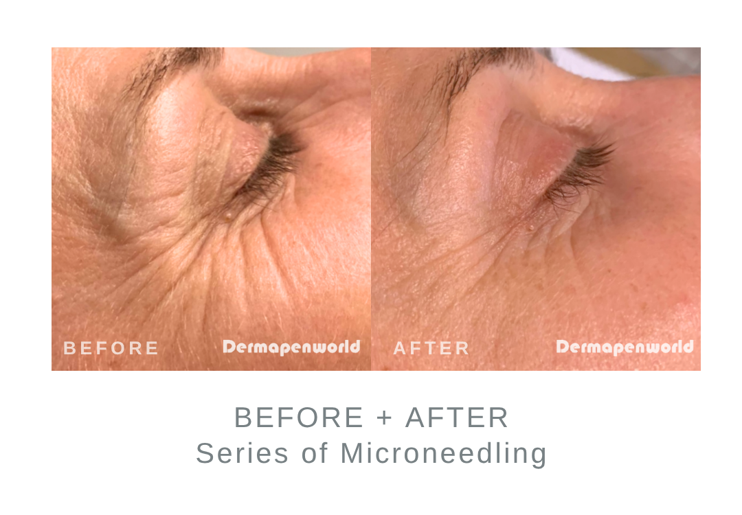 Before and After Microneedling for Wrinkles | DermaEnvy Skincare