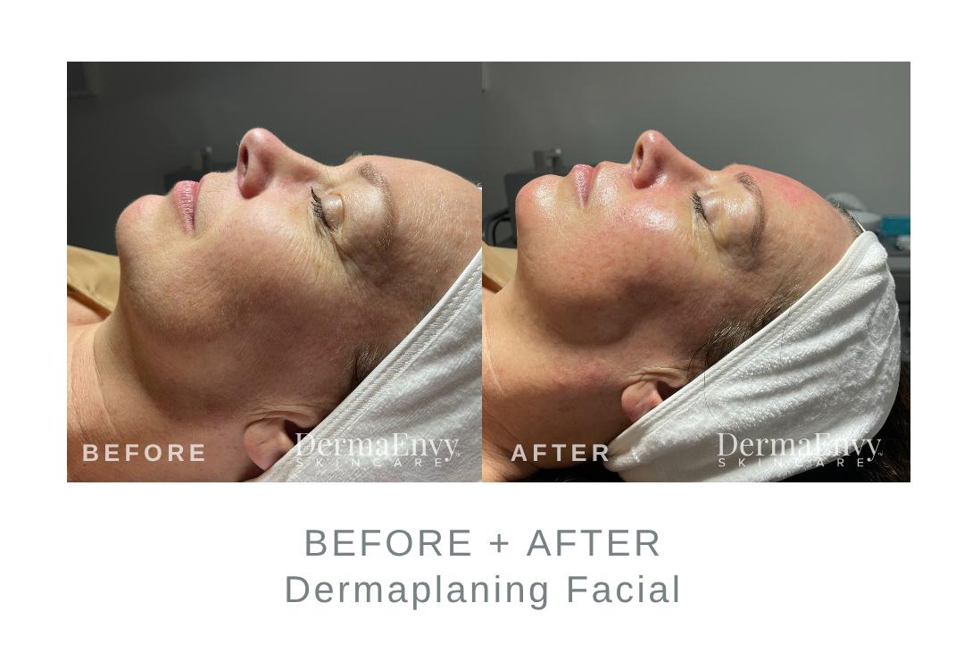 Before and After Dermaplaning | DermaEnvy Skincare