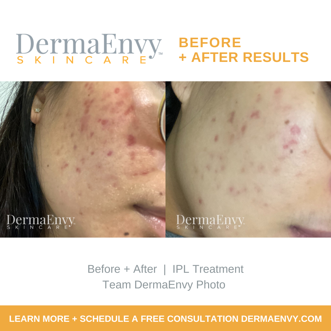 Comparison of a person's cheek before and after IPL treatment showing reduced acne scars and skin blemishes