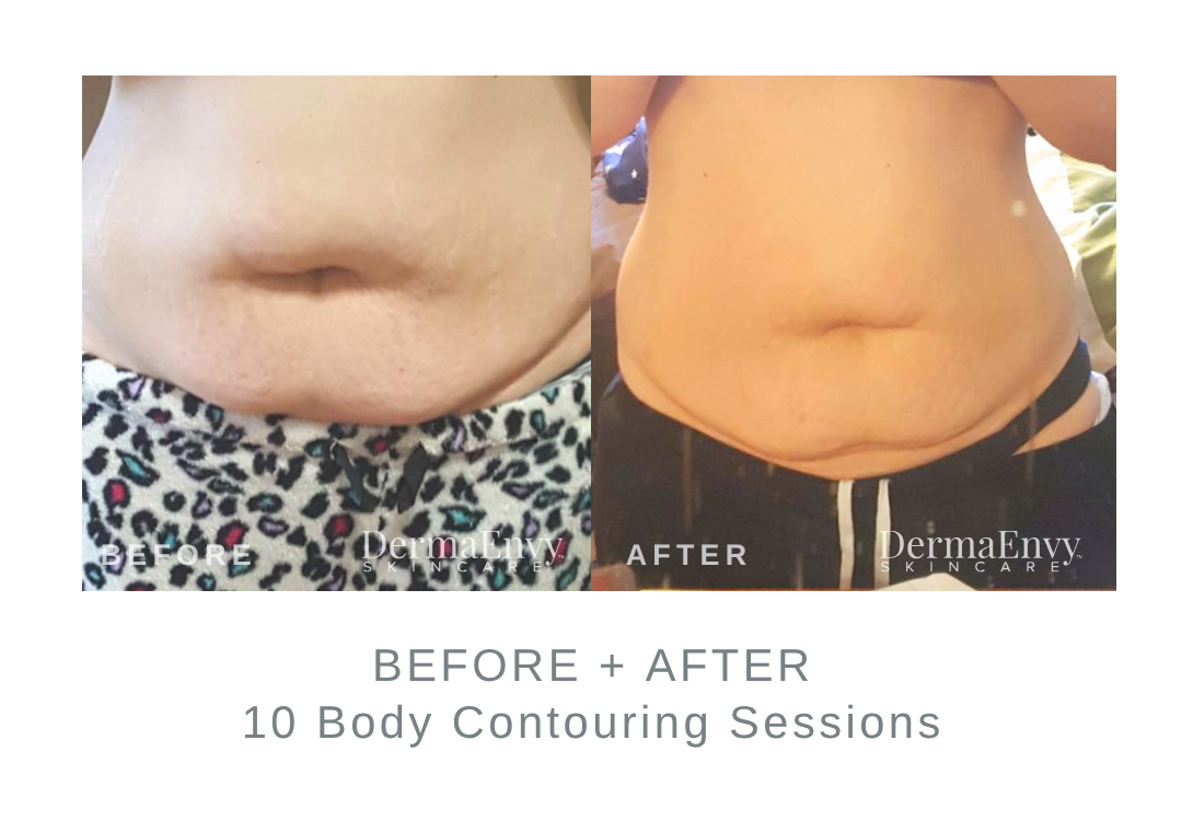 Before and After Body Contouring | DermaEnvy Skincare