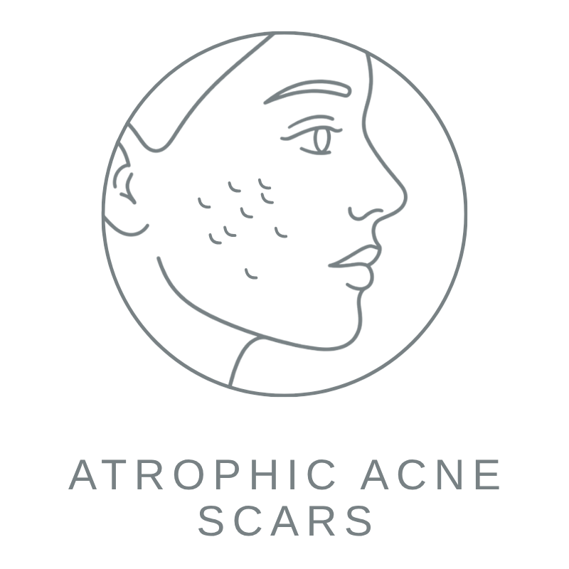 Atrophic Acne Scars 