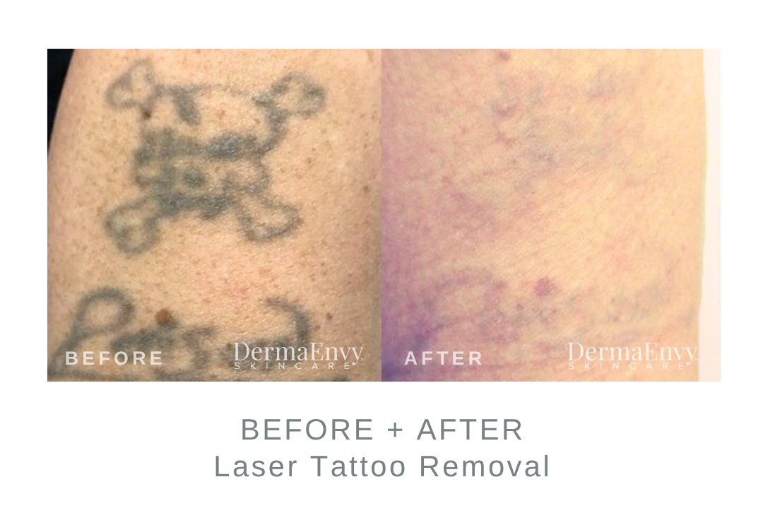 Before and After Tattoo Removal | DermaEnvy Skincare