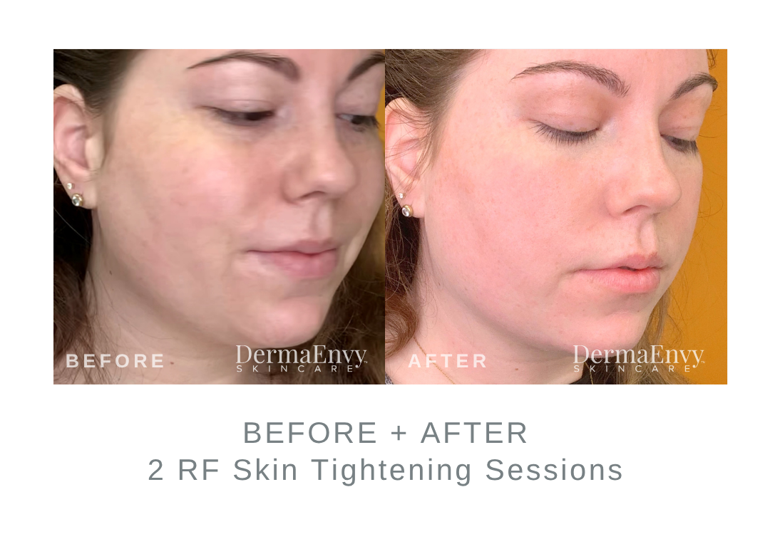 Before and After RF Skin Tightening on the Face | DermaEnvy Skincare