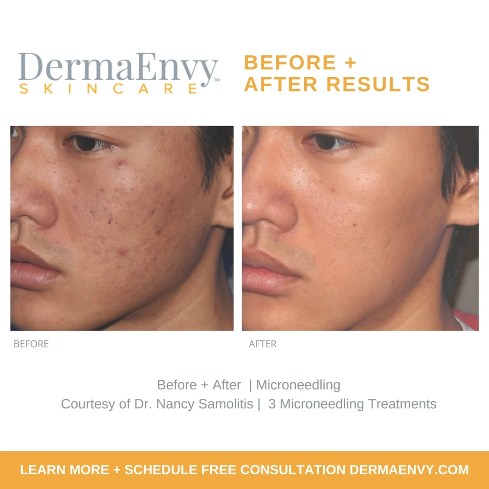 VAMP Facial Salmon DNA Microneedling Treatment | Discover Youthful Skin ...