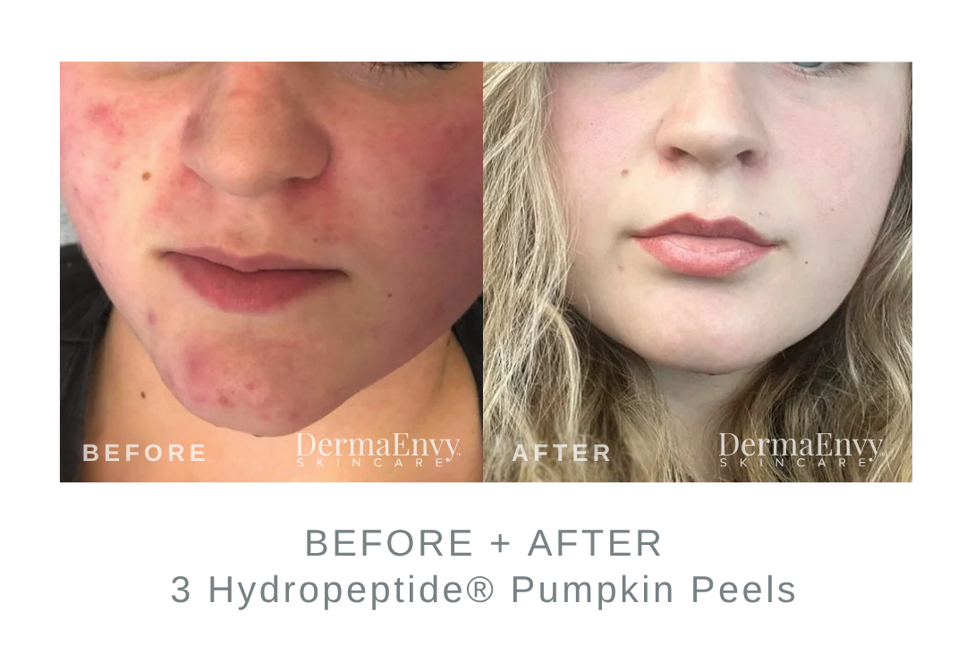 Before and After 3 Hydropeptide Pumpkin Peels | DermaEnvy Skincare
