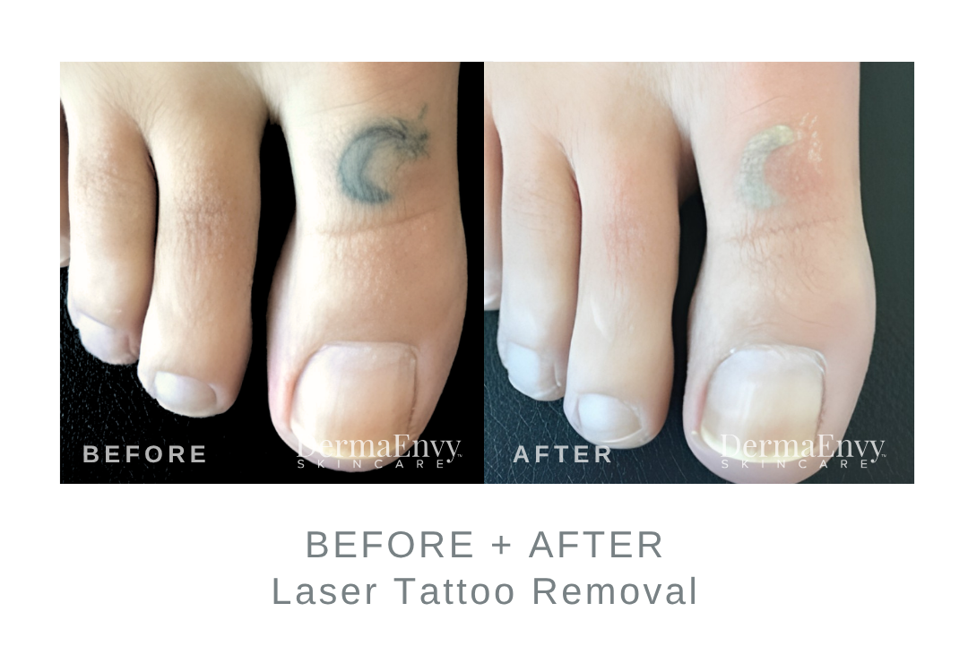 Before and After Tattoo Removal | DermaEnvy Skincare